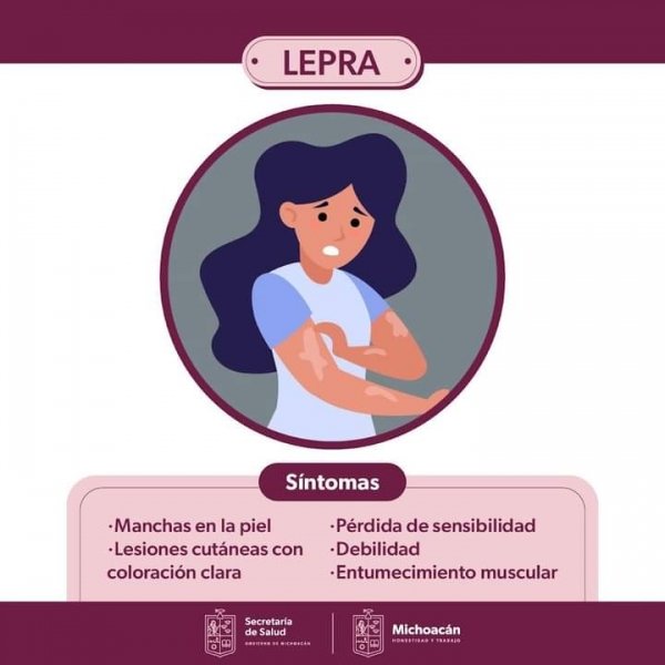 Michoacán garantiza la atención gratuita a pacientes con lepra